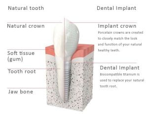 dentalimplantcrownstoothreplacement